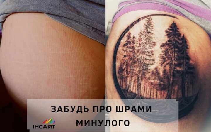 Запорожцам, пострадавшим от насилия или селфхарма, предлагают перекрыть шрамы татуировкой