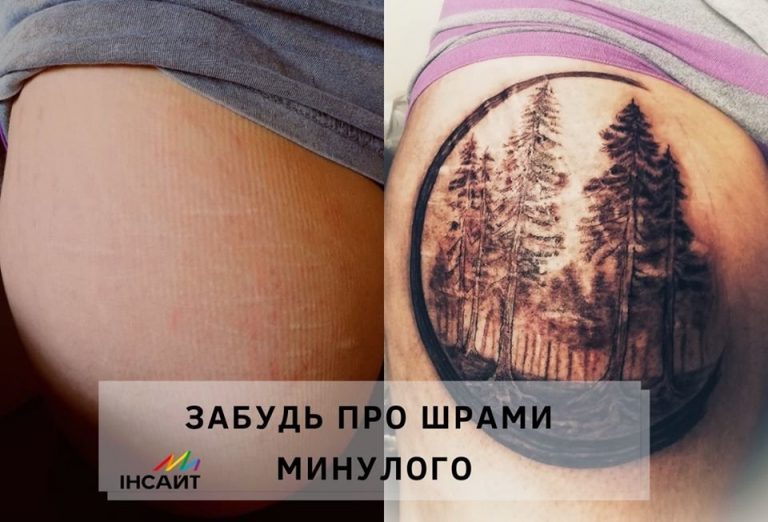 Запорожцам, пострадавшим от насилия или селфхарма, предлагают перекрыть шрамы татуировкой